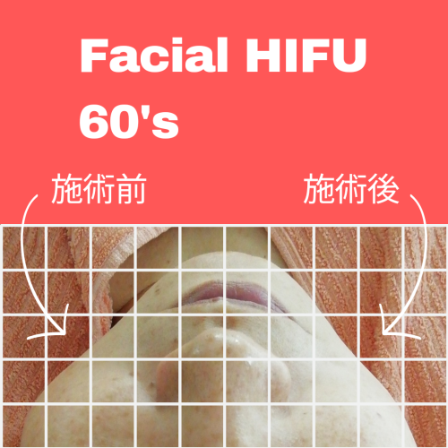 フェイシャルハイフが凄すぎた!