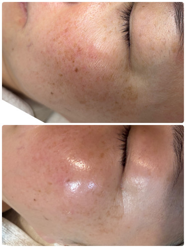 プロセルフェイシャル×3回