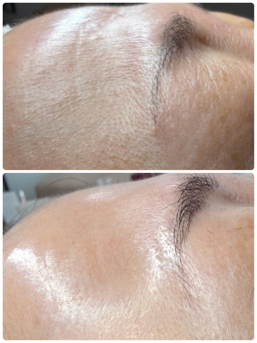 プロセルフェイシャル×1回