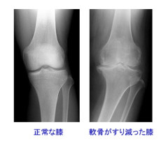 変形性膝関節症（いわゆる膝のすり減り）の治療