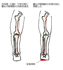 変形性膝関節症の治療　 保存療法2　装具療法（サポーター、靴の中敷き）