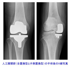 人工膝関節置換術について 　　もう一度しっかり歩けるようにする最後の手段