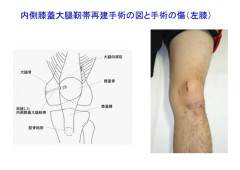 膝蓋骨脱臼の治療　　再脱臼が起こった場合は手術を考える