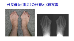 外反母趾（がいはんぼし）の治療 目標は形を治すことではなく、痛みが少なく歩きやすい足をめざします