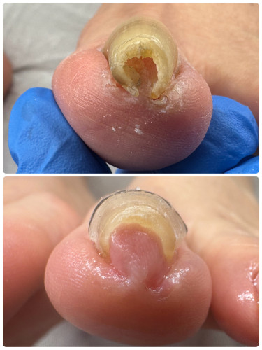 筒状に丸まった巻き爪