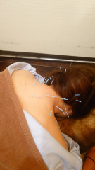 鍼灸