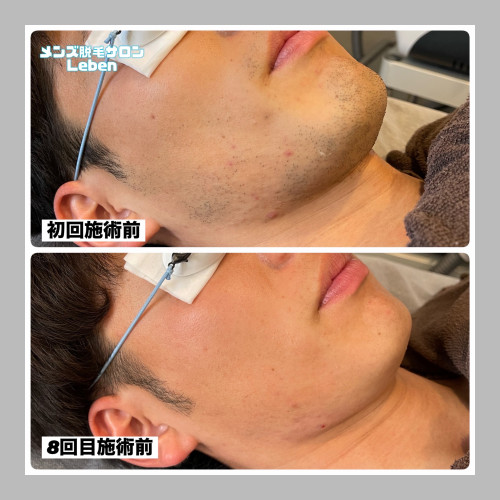 ヒゲ脱毛まだしてないの??