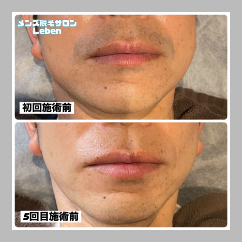 まだしてないの?ヒゲ脱毛‼️