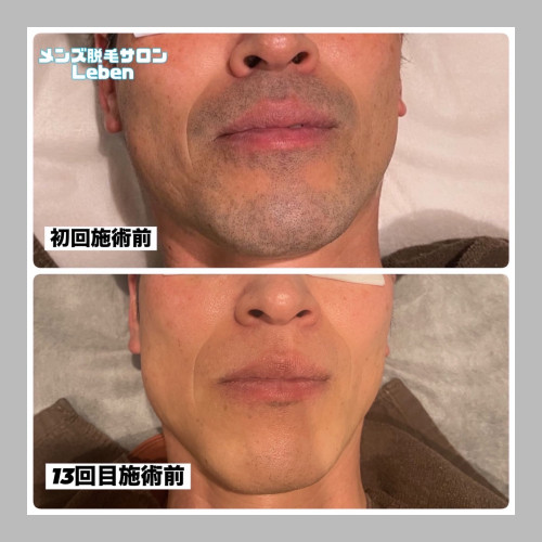 青ヒゲはヒゲ脱毛で解決✌️