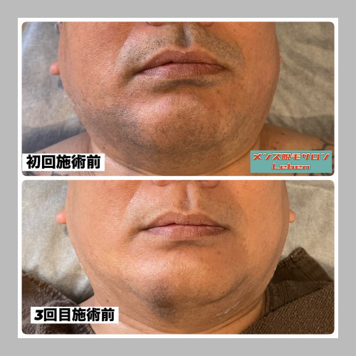 北九州ヒゲ脱毛はLebenにお任せ‼️