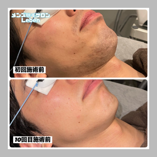 ヒゲ脱毛1,000円は今月まで!!