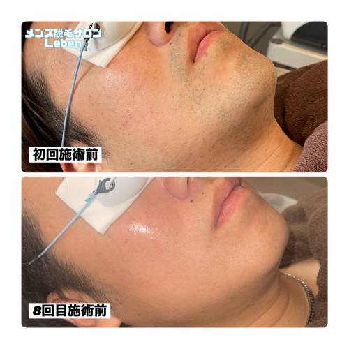 北九州市ヒゲ脱毛 No.1はメンズ脱毛サロンLeben