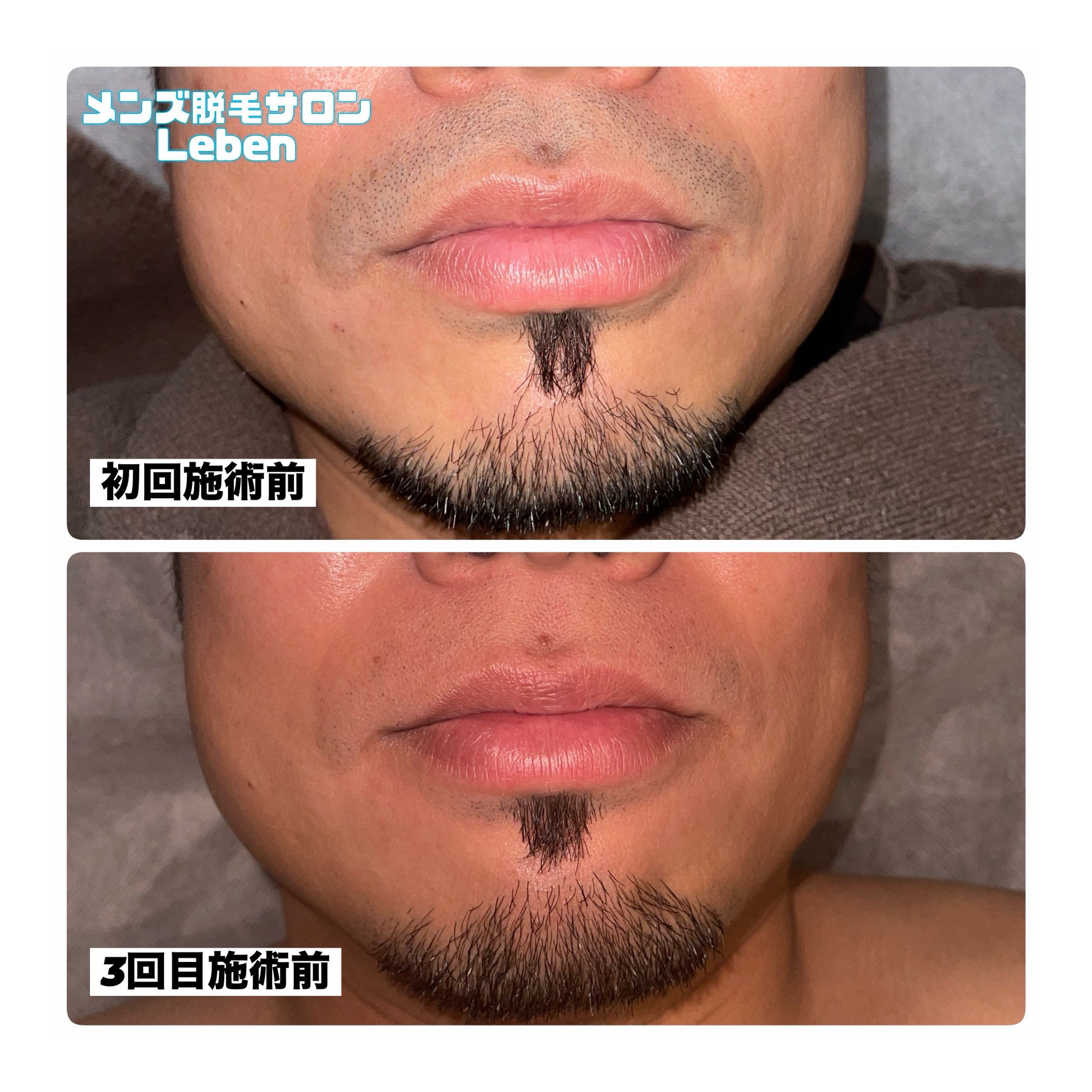 青ヒゲ気になりませんか?