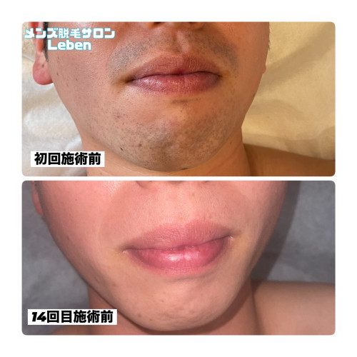 北九州市ヒゲ脱毛初回3,000円