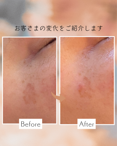 リセルシュール美容機器でシミが消える