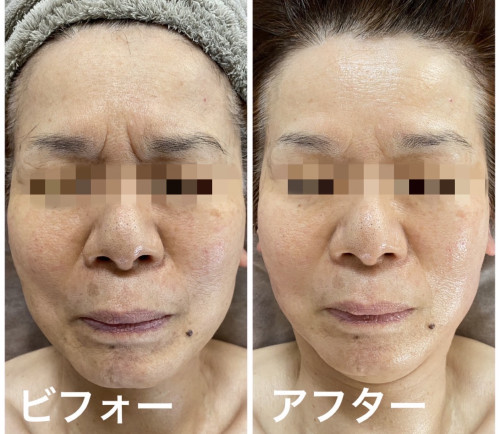 アジャスト3Dトリートメント