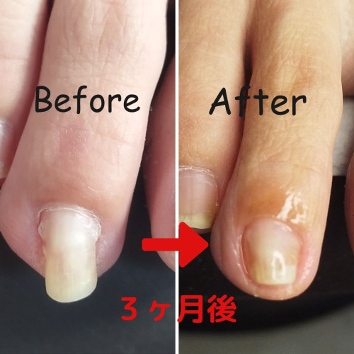 第二趾（人差し指）の巻き爪ケア
