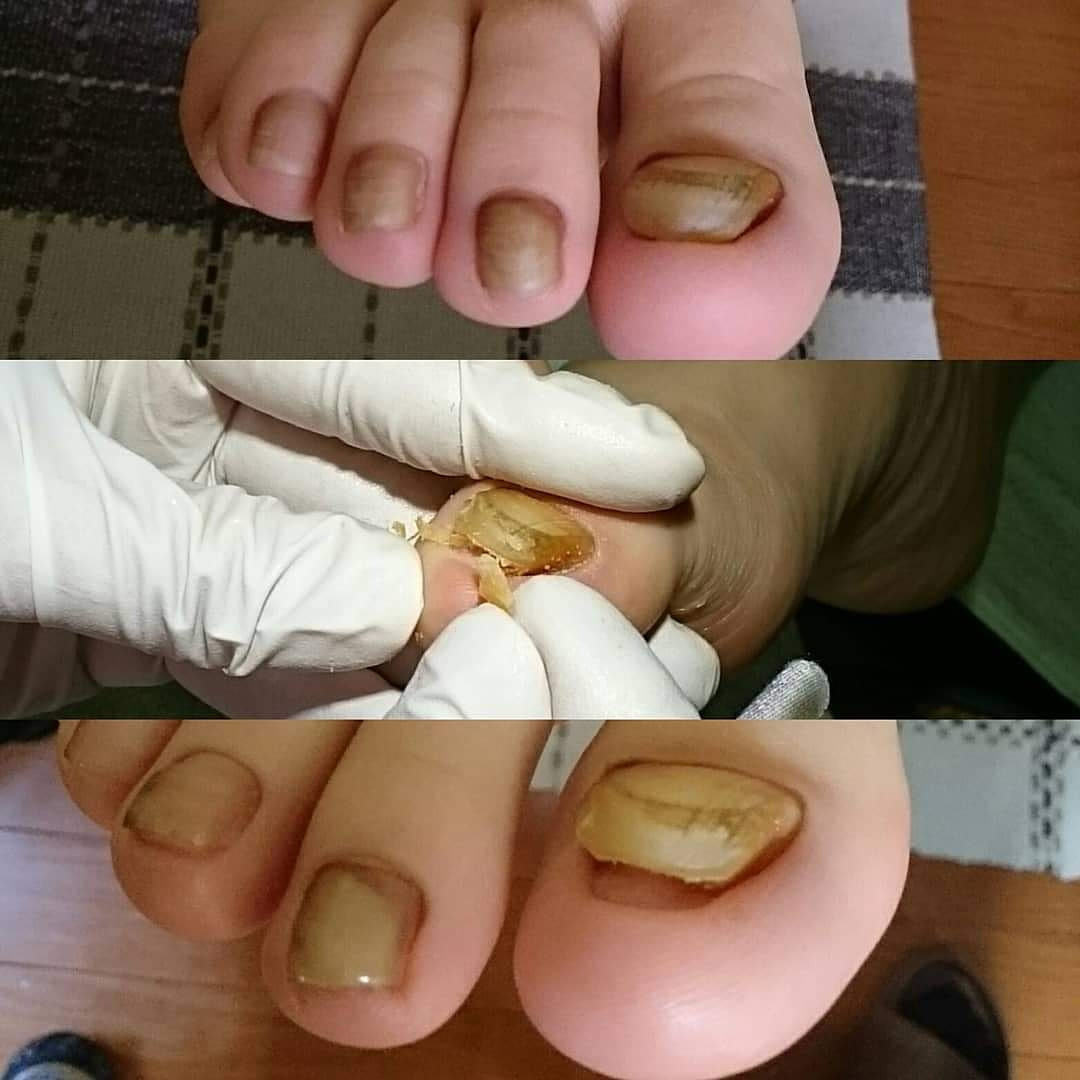 足の爪切り トラブル爪 自爪ケア 巻き爪 ・ 肥厚爪 ・ 爪甲鉤彎症 爪本来の美しさを取り戻す、足に適切な正しい爪の形、長さに整えます