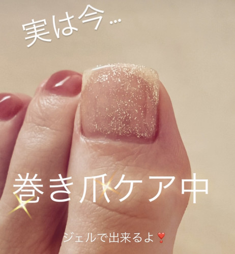 巻き爪ケアジェル📢