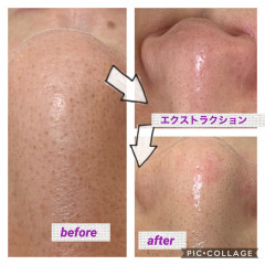 学生毛穴エクストラクション