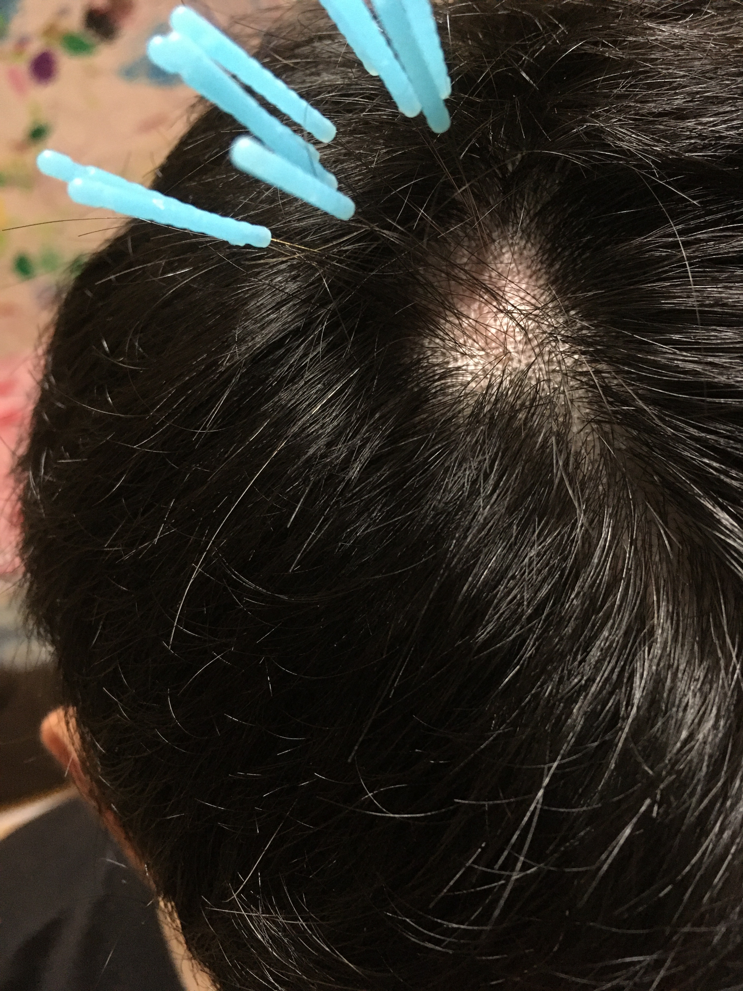 薄毛や脱毛への鍼施術