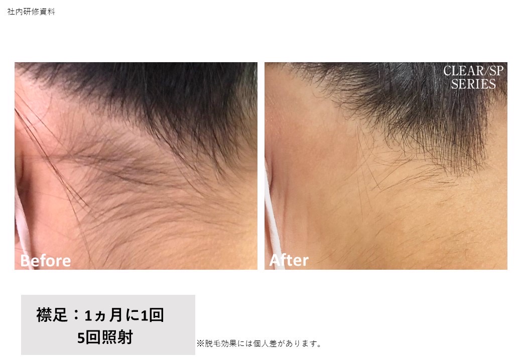 【周年記念キャンペーン】3カ所脱毛1回