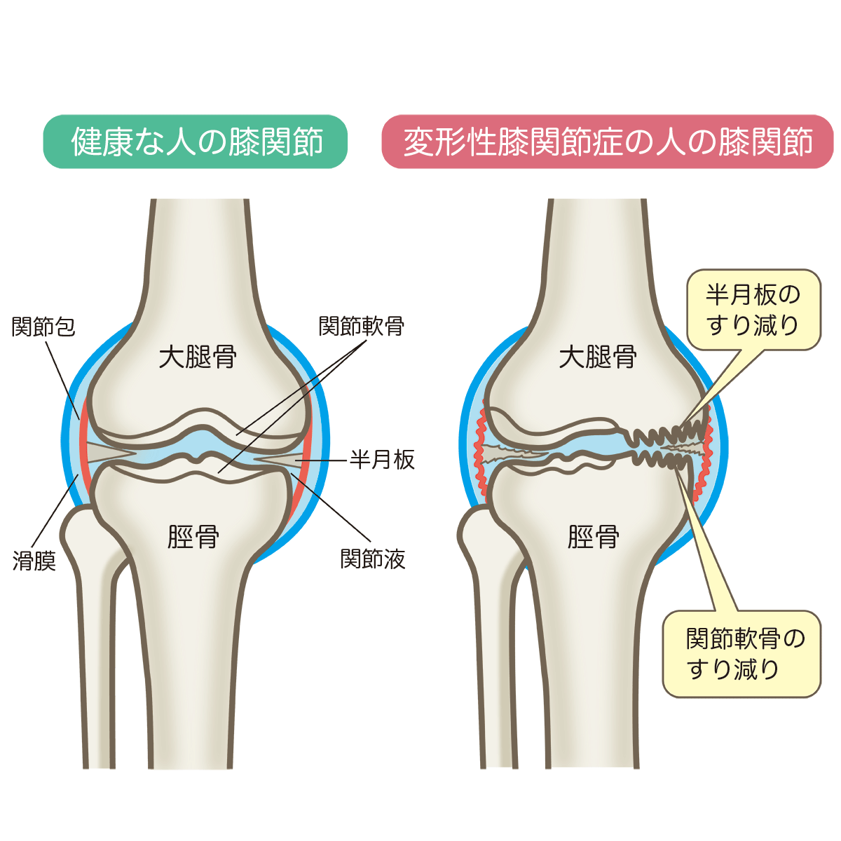 osteoarthritis-of-the-knee.png