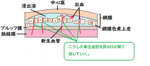 脈絡膜新生血管.png