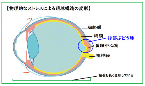 後部ぶどう腫.png