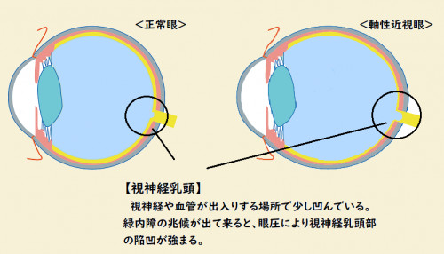 緑内障なりかけ.png