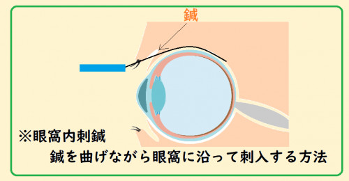 眼窩内刺鍼.png