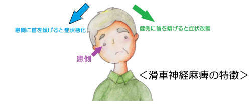 滑車神経麻痺.jpg