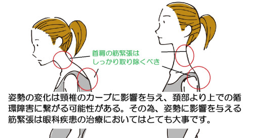 筋緊張と眼科疾患.jpg
