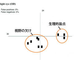 右眼1回目.jpg