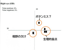 右眼1か月後.jpg