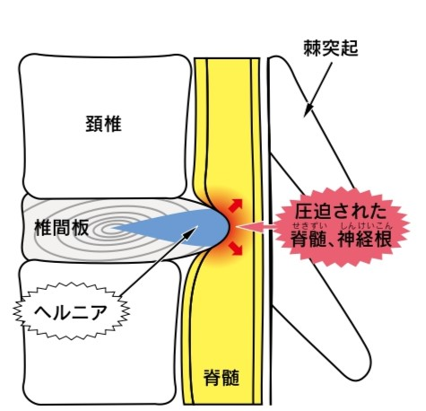 hernia1.png