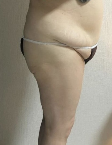 腹たるみ.jpg