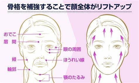 骨格補強でリフトアップ.jpg