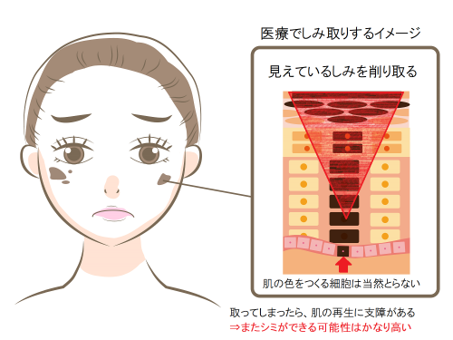 医療でしみをとるイメージ.png