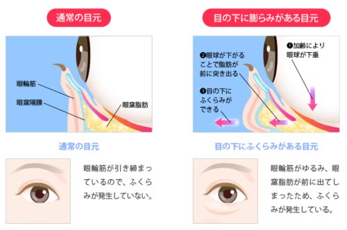 目のたるみイラスト.png