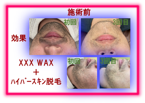 男性おひげ