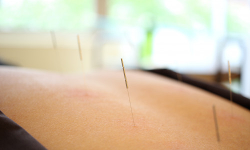 全身鍼灸治療イメージ