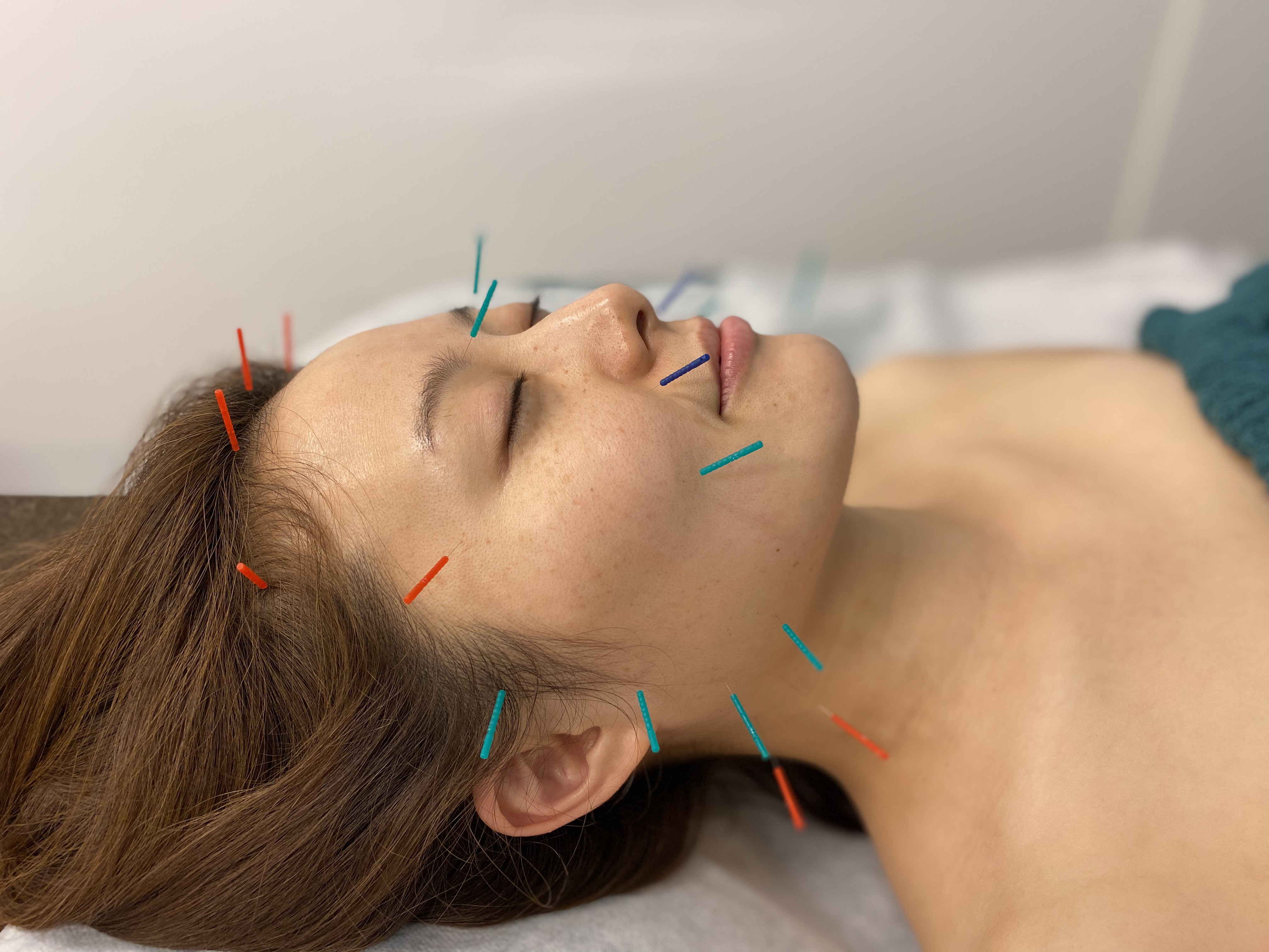 美顔鍼灸イメージ