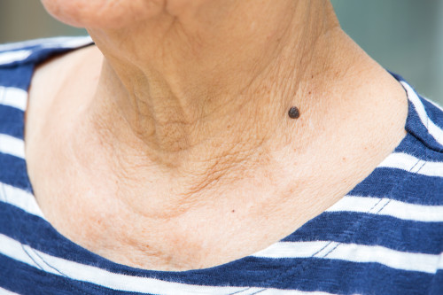 ほくろ.jpg