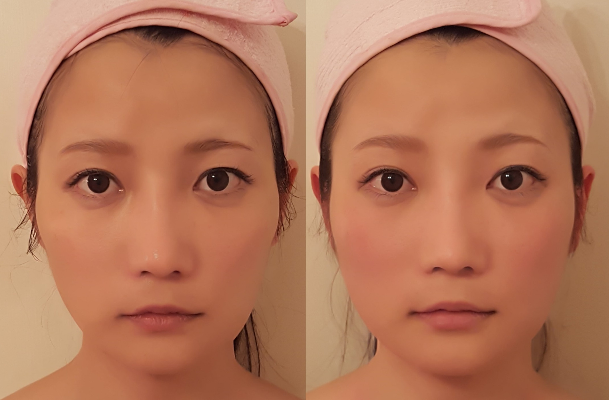 施術結果写真ビフォーアフター 韓国直伝小顔骨気 マジェンタコルギシャンスクール