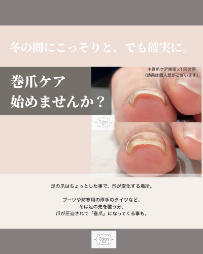 巻き爪矯正.jpeg