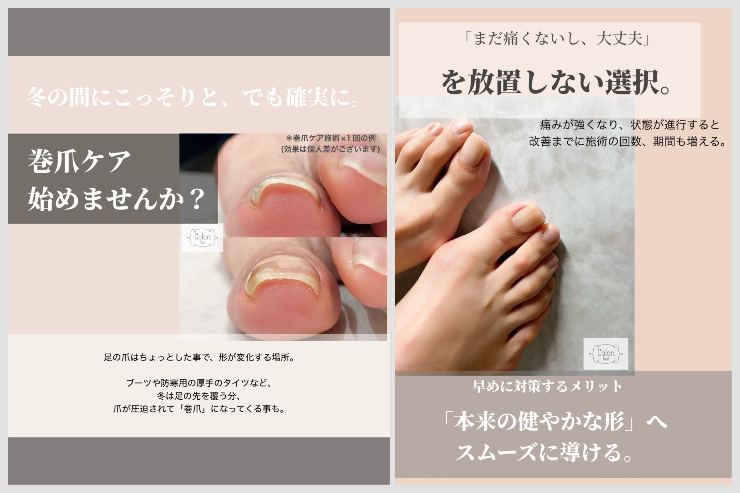 巻爪ケアのご案内