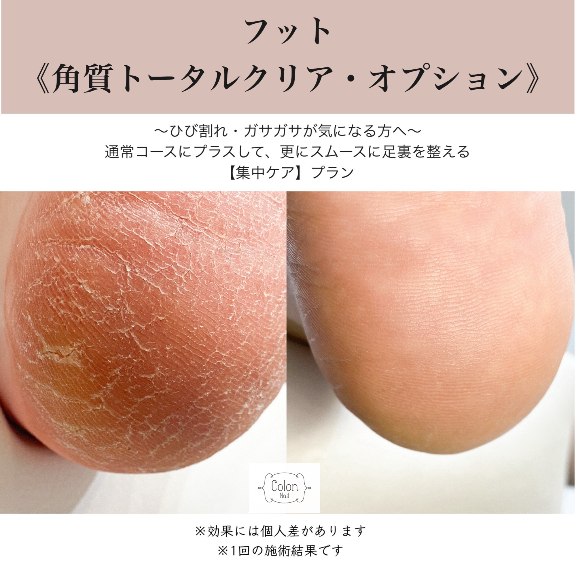 素足が喜ぶ！新フット角質ケアオプションのご案内
