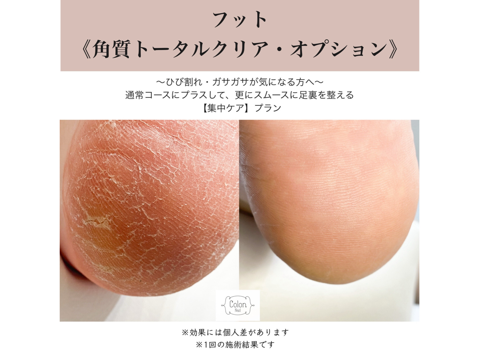 New☆オプションフット「角質ケア」のご案内