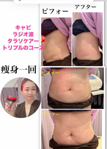 部分痩身キャビテーション＆ラジオ波＆ハンド　